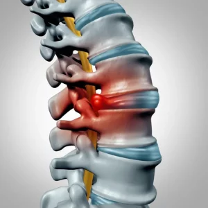 Cervical disc herniation and lumbar disc herniation